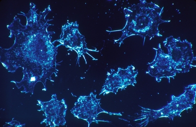 La ciencia israelí y la italiana se unen en un novedoso esfuerzo contra el cáncer.